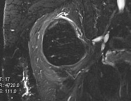 Lipoma Intramuscular0002